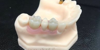 Dental implant 3d printed models