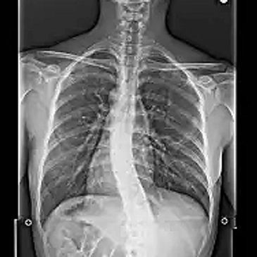 X-ray image showing a spine with scoliosis curvature
