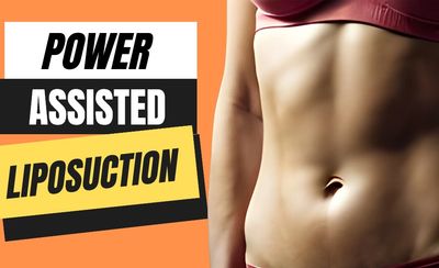 power assisted liposuction in sonora