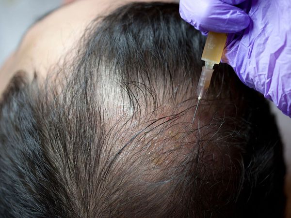 balding male scalp with gloved hand giving shot