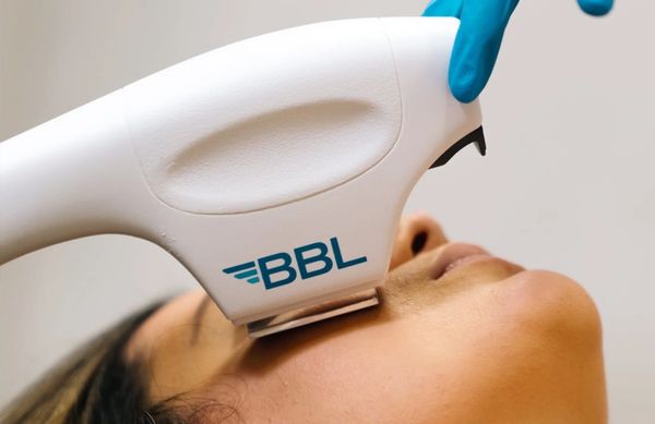 woman getting BBL laser treatment