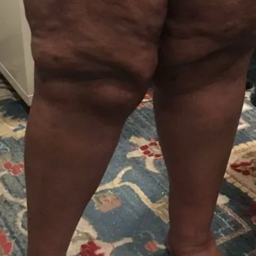 Lipedema