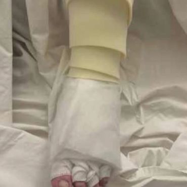 decongestive therapy