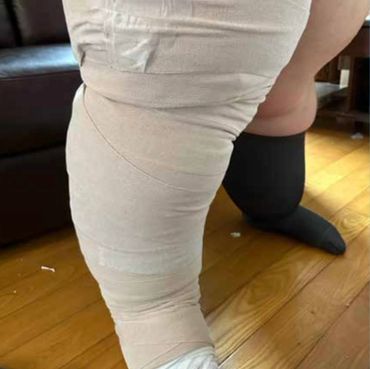 complete decongestive therapy