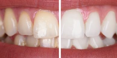 Comparison of teeth before and after whitening treatment.