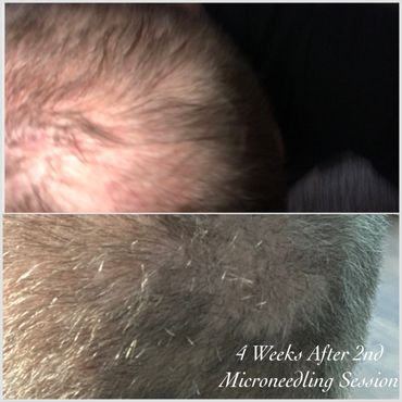 Hair restoration