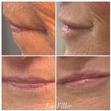 Juvederm fillers