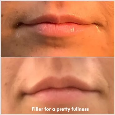 Juvéderm filler