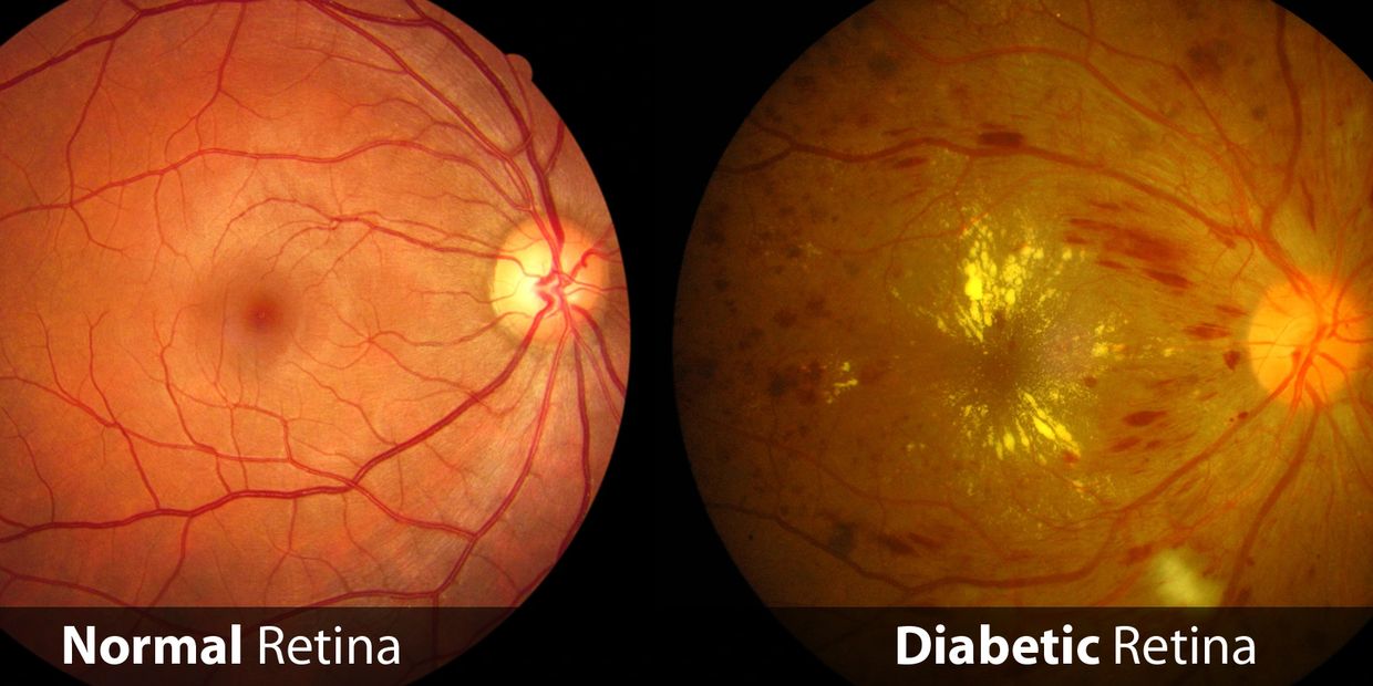 Normal retina versus a patient with diabetic retinopathy
