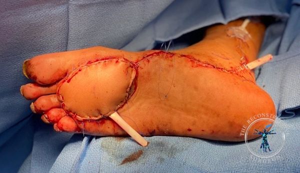 Dr. Felder TDAP flap foot reconstruction