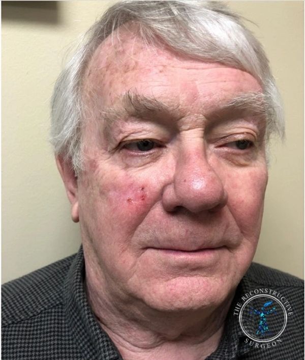 Dr. John Felder treats basal cell skin cancer of the cheek