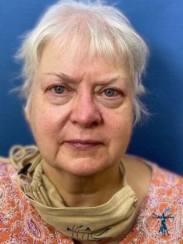 Dr. John Felder treats skin cancer of the nose after Mohs surgery, before and after