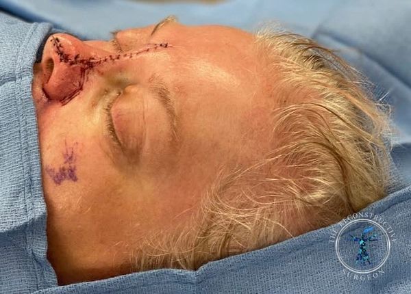 Dr. John Felder treats skin cancer of the nose after Mohs surgery, before and after