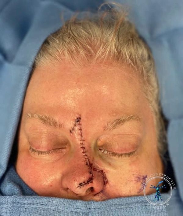 Dr. John Felder treats skin cancer of the nose after Mohs surgery, before and after