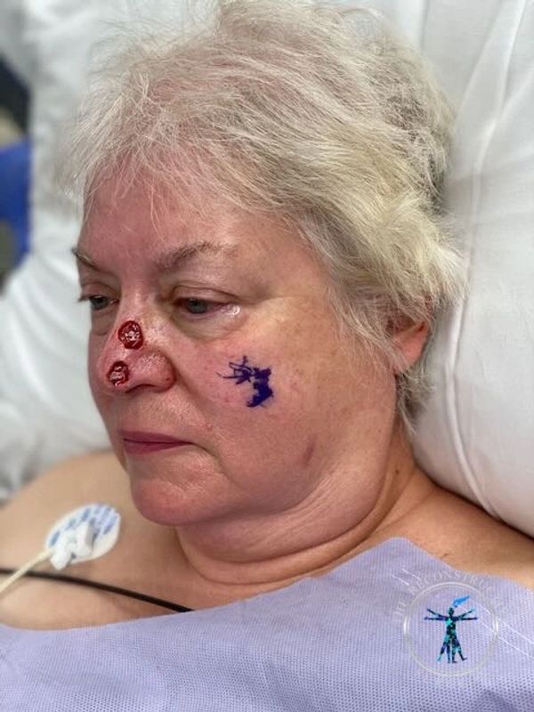 Dr. John Felder treats skin cancer of the nose after Mohs surgery, before and after