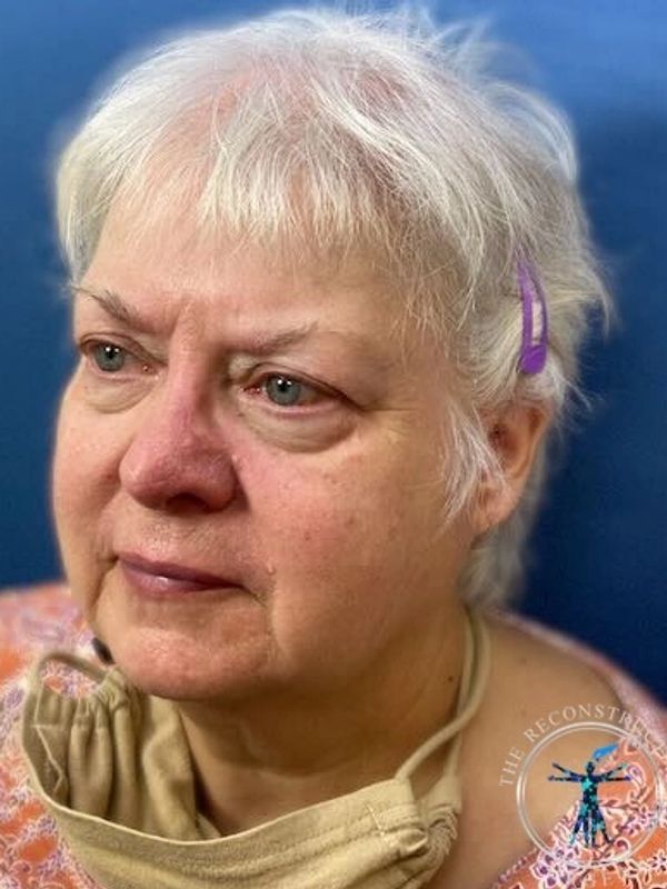 Dr. John Felder treats skin cancer of the nose after Mohs surgery, before and after