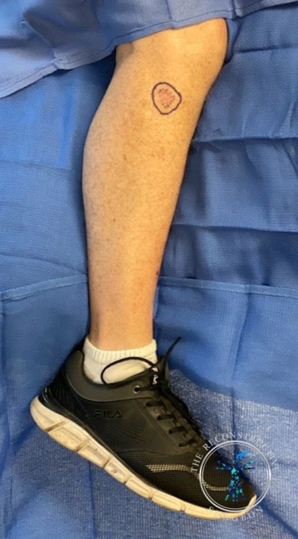 Skin cancer of the leg