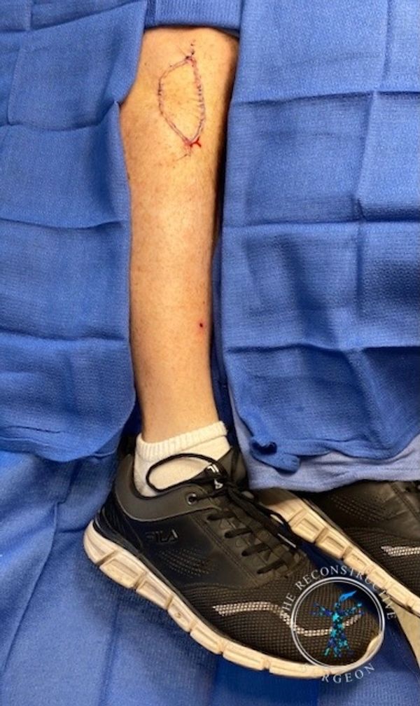 leg skin cancer keystone flap
