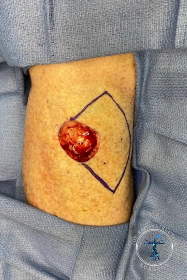 Leg Mohs defect keystone flap