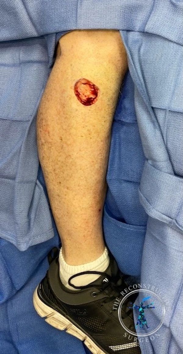 Leg Mohs defect