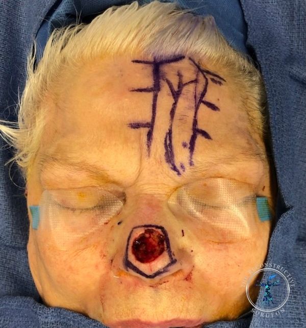 Dr. Felder plastic surgery reconstructs nose after Mohs surgery with forehead flap before and after