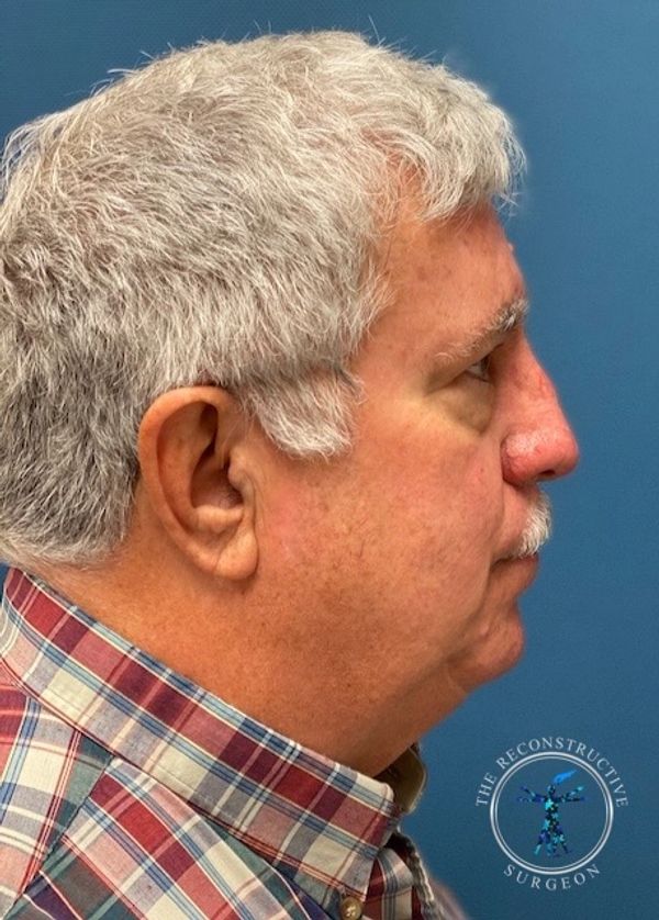 Dr. John Felder treats basal cell skin cancer of the nose with Integra, before and after