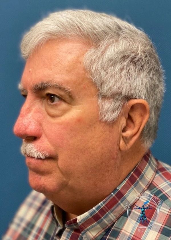 Dr. John Felder treats basal cell skin cancer of the nose with Integra, before and after