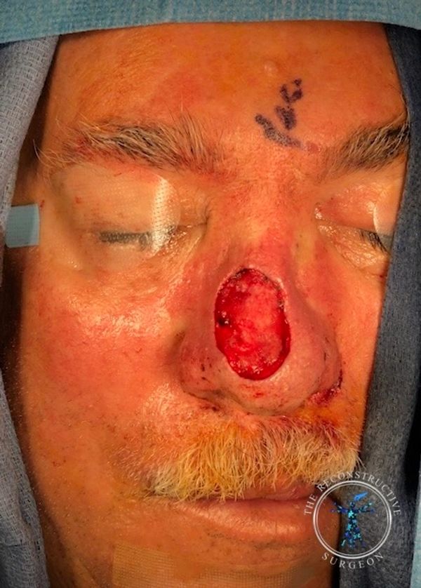 Dr. John Felder treats basal cell skin cancer of the nose with Integra, before and after