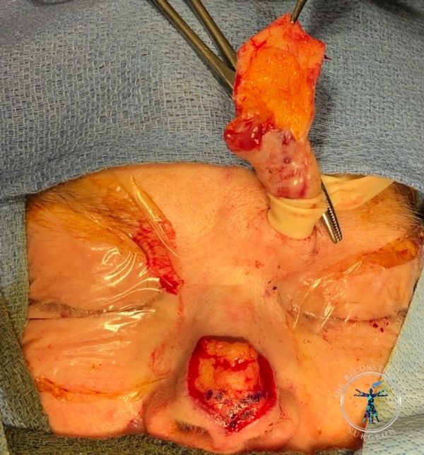 Dr. Felder plastic surgery reconstructs nose after Mohs surgery with forehead flap before and after
