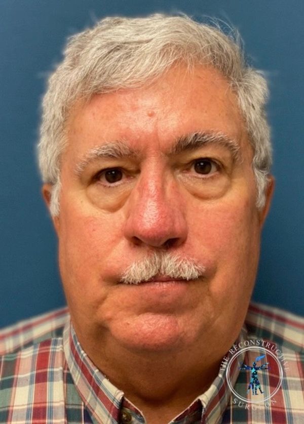 Dr. John Felder treats basal cell skin cancer of the nose with Integra, before and after