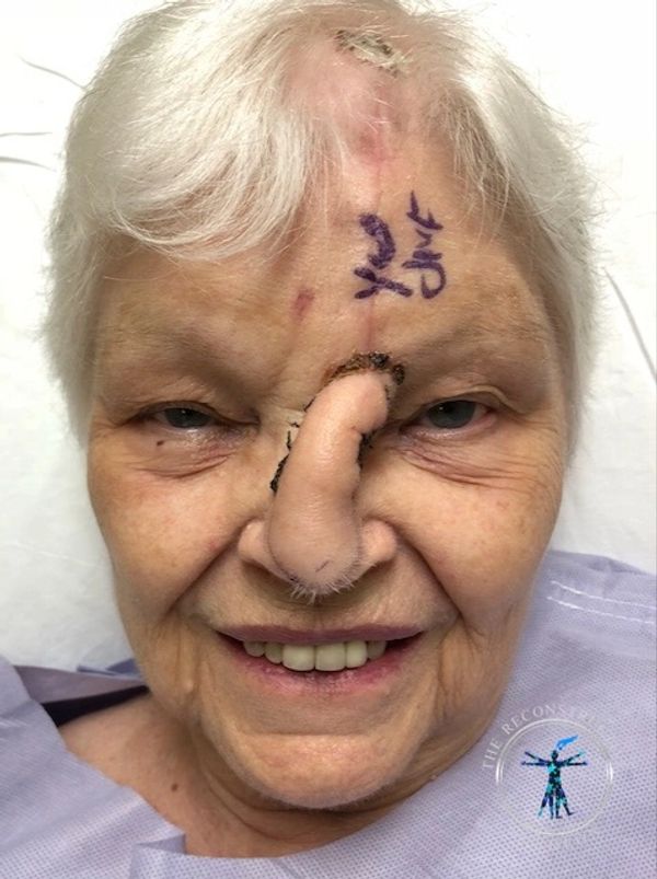 Dr. Felder plastic surgery reconstructs nose after Mohs surgery with forehead flap before and after