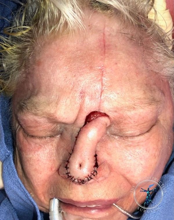 Dr. Felder plastic surgery reconstructs nose after Mohs surgery with forehead flap before and after