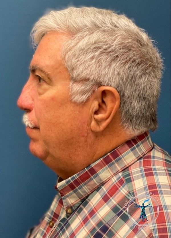 Dr. John Felder treats basal cell skin cancer of the nose with Integra, before and after