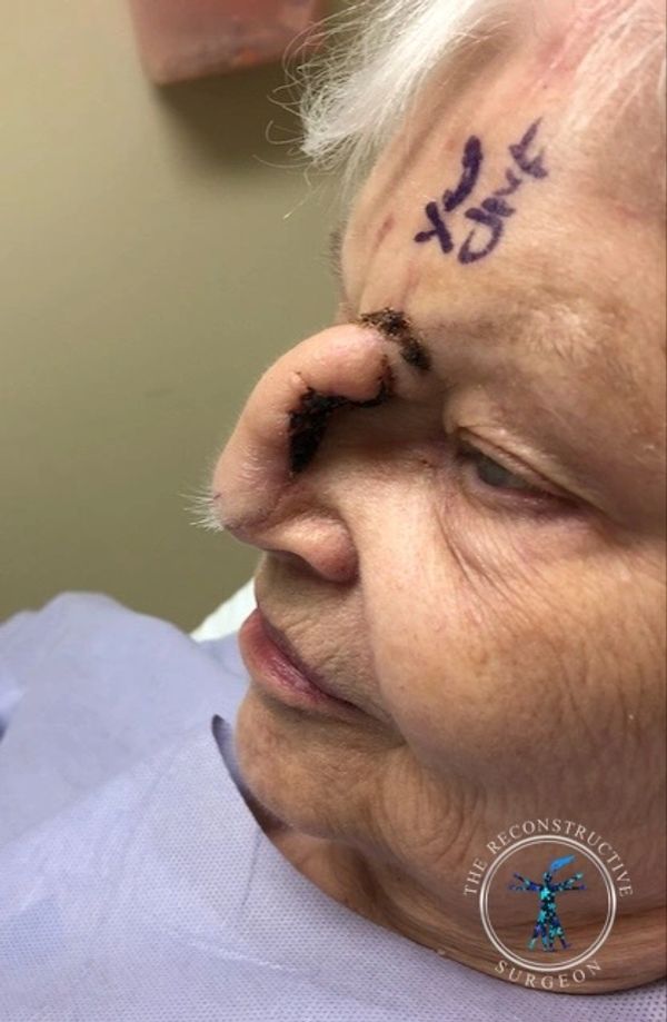 Dr. Felder plastic surgery reconstructs nose after Mohs surgery with forehead flap before and after