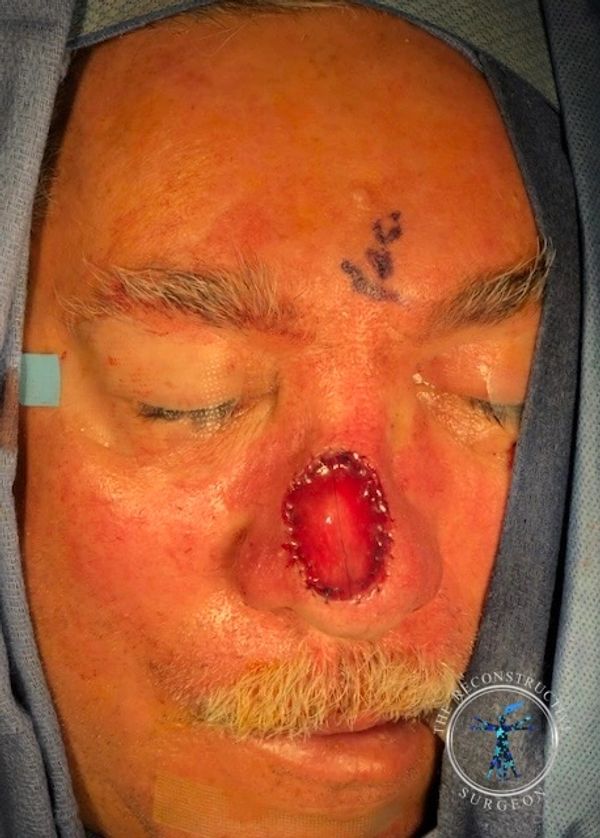 Dr. John Felder treats basal cell skin cancer of the nose with Integra, before and after