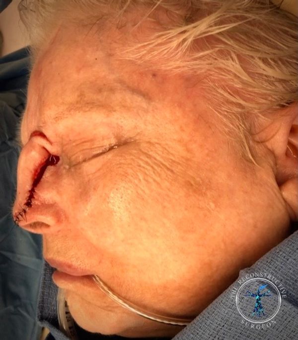Dr. Felder plastic surgery reconstructs nose after Mohs surgery with forehead flap before and after