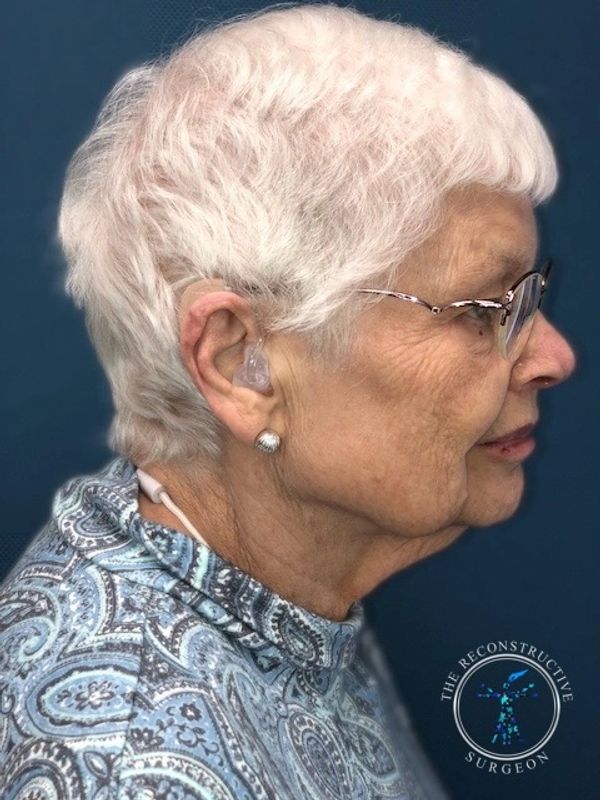 Dr. Felder plastic surgery reconstructs nose after Mohs surgery with forehead flap before and after
