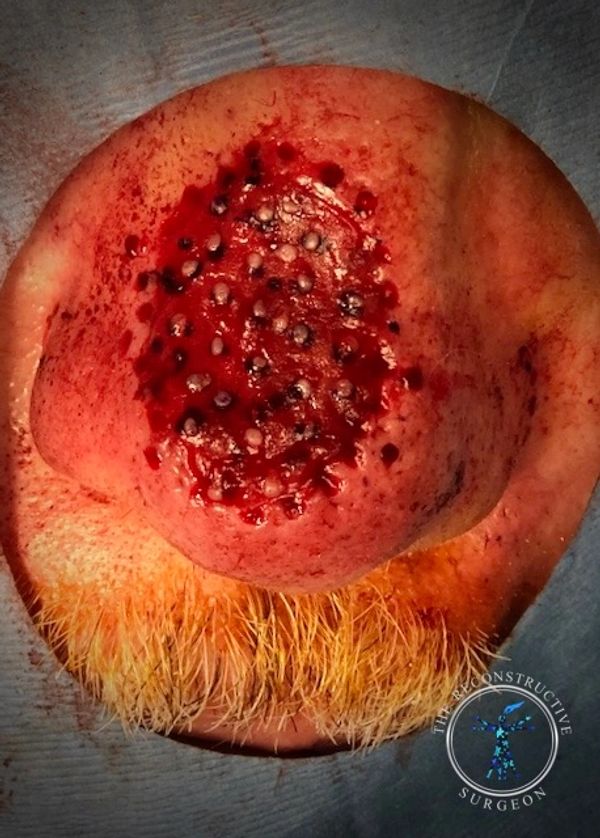 Dr. John Felder treats basal cell skin cancer of the nose with Integra, before and after