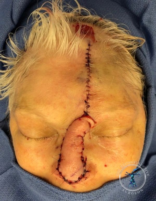 Dr. Felder plastic surgery reconstructs nose after Mohs surgery with forehead flap before and after