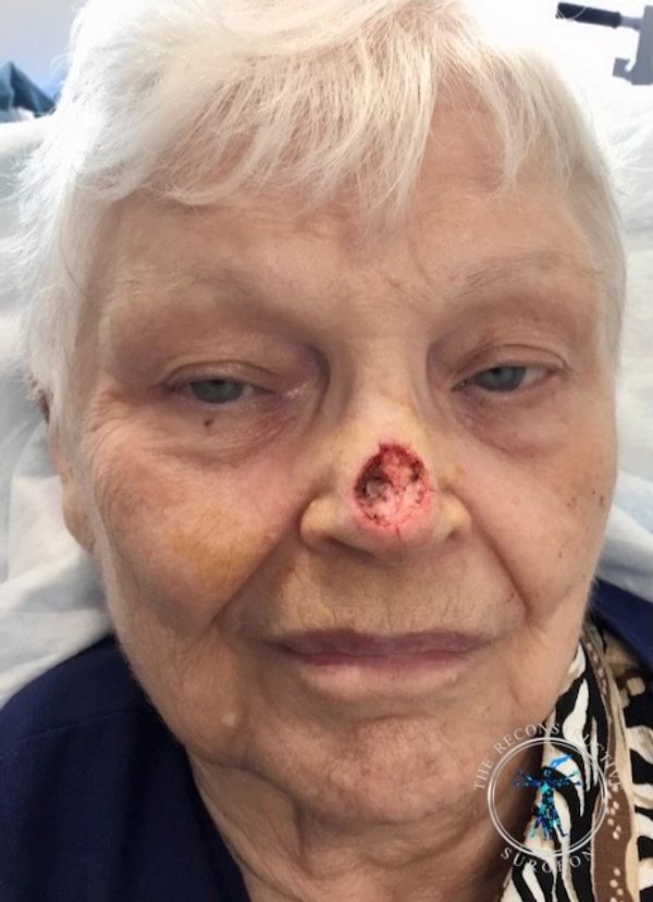 Dr. Felder plastic surgeon reconstructs nose after Mohs surgery with forehead flap before and after
