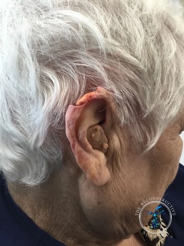 Dr. John Felder reconstructs skin cancer of the ear after Mohs surgery before and after