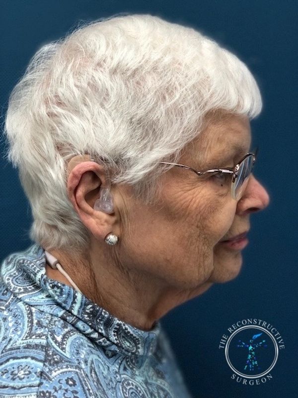 Dr. John Felder plastic surgery reconstructs skin cancer of the ear before and after