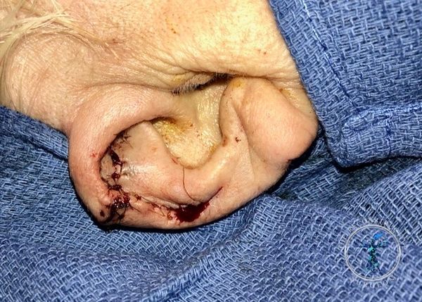 Dr. John Felder plastic surgery reconstructs skin cancer of the ear