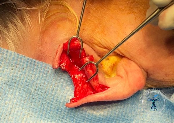 Dr. John Felder plastic surgery reconstructs skin cancer of the ear