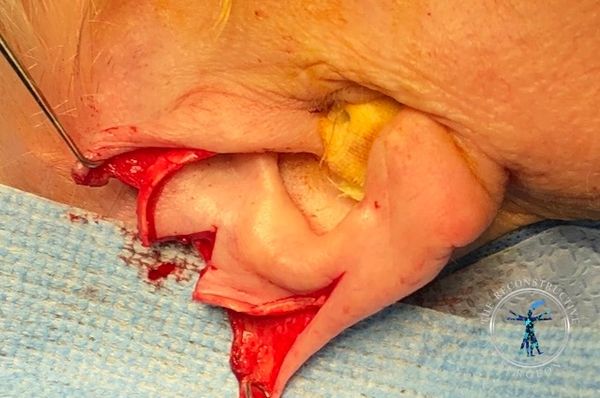 Dr. John Felder plastic surgery reconstructs skin cancer of the ear