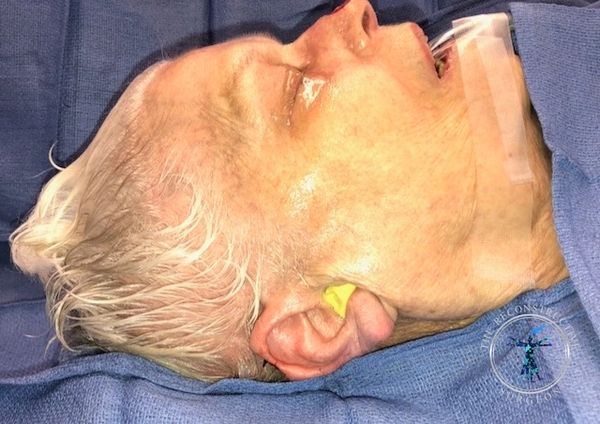 Dr. John Felder plastic surgery reconstructs skin cancer of the ear