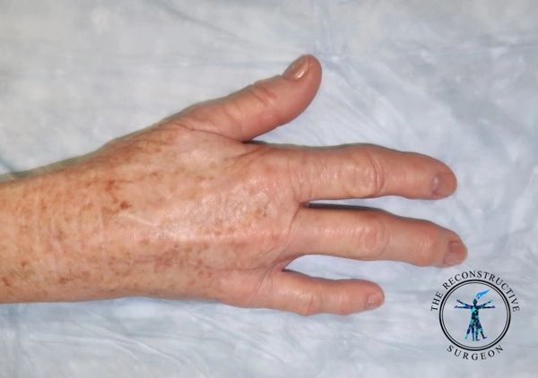 Hand with ray amputation