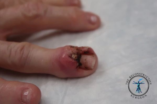 Skin cancer surgery of the hand