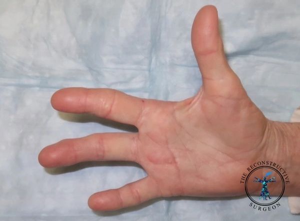 Ray amputation of finger