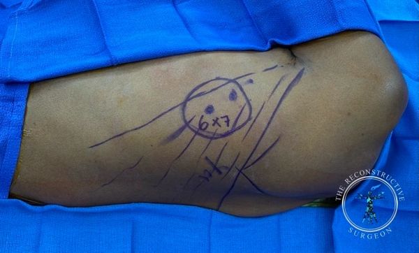 Dr. Felder - thoracodorsal artery perforator free flap - TDAP flap